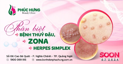 Phân biệt bệnh thủy đậu, zona và Herpes Simplex