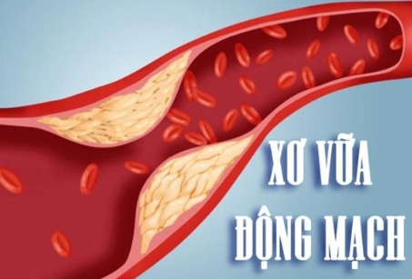 Hãy tầm soát xơ vữa động mạch ngay hôm nay